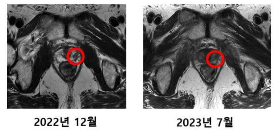 국내 첫 중입자치료 환자 최씨의 MRI 사진